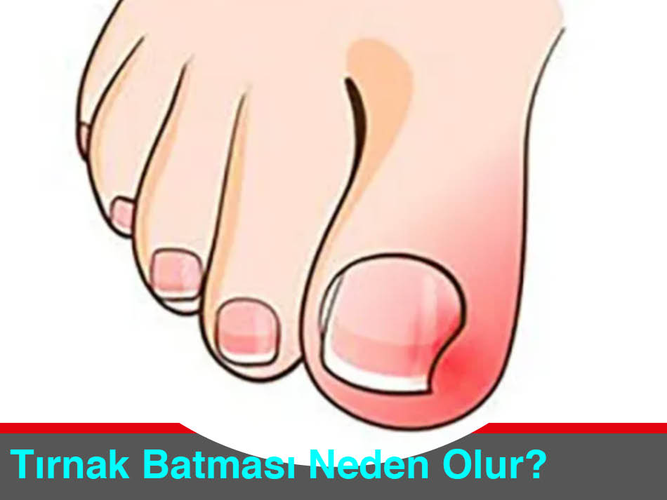 Tırnak Batması Nasıl Önlenir